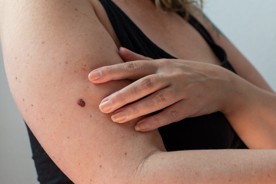 woman checking her skin for an abnormal mole for signs of melanoma skin cancer