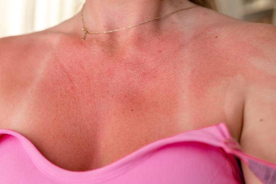 Sunburned skin on shoulders and chest after a day at the beach in warm summer weather