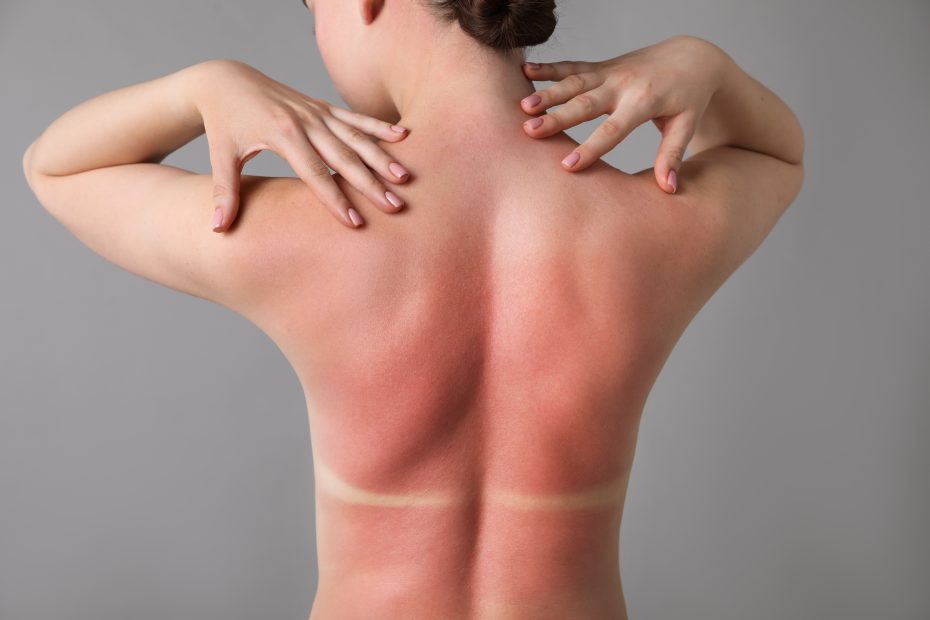 Woman with sunburned skin on grey background, back view