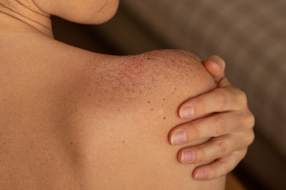 skin peeling on woman's shoulders, sunburn, pain, unhealthy, uv