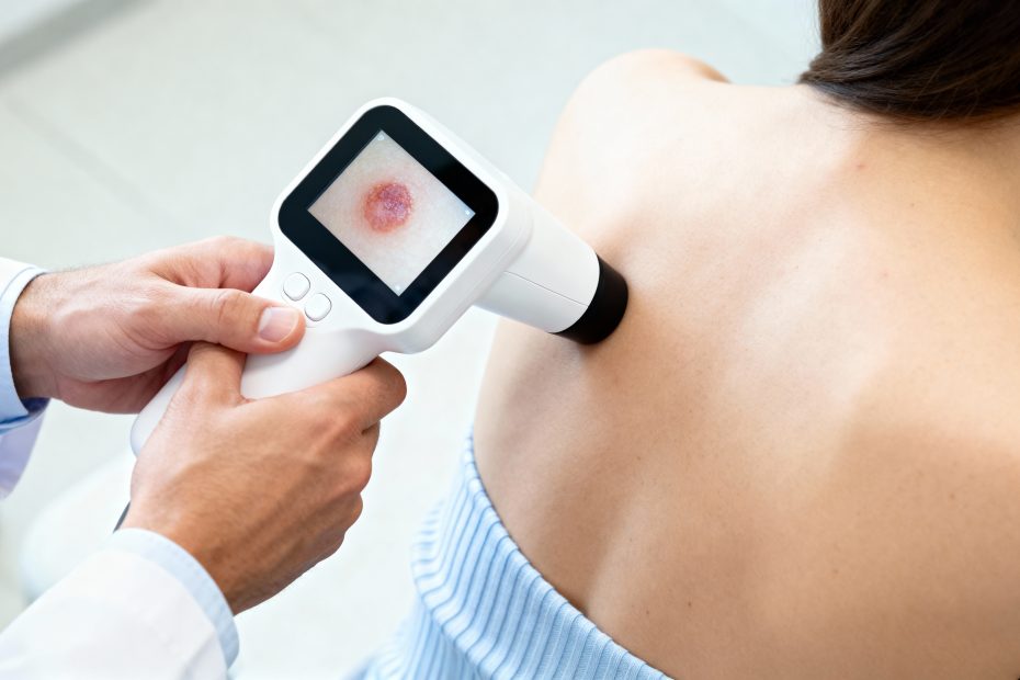 Dermatologist examining a mole on a patients back with a dermatoscope skin cancer prevention early detection