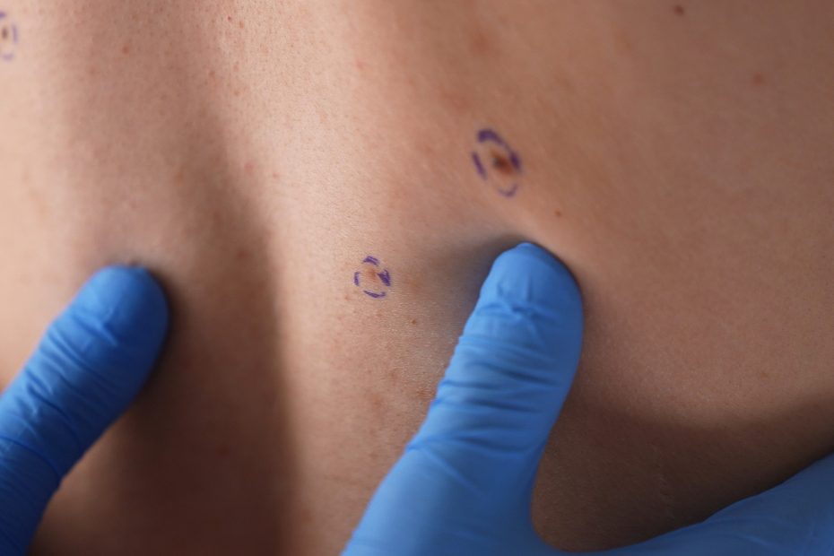 Dermatologist in blue gloves examines a marked mole on a hairy male back during skin cancer screening and plastic surgery consultation.